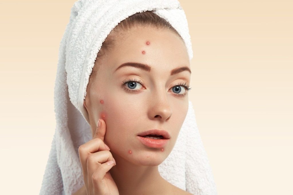 The Best Products for Acne Prone Skin 