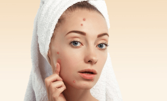 Top 5 Skin care Products for Acne