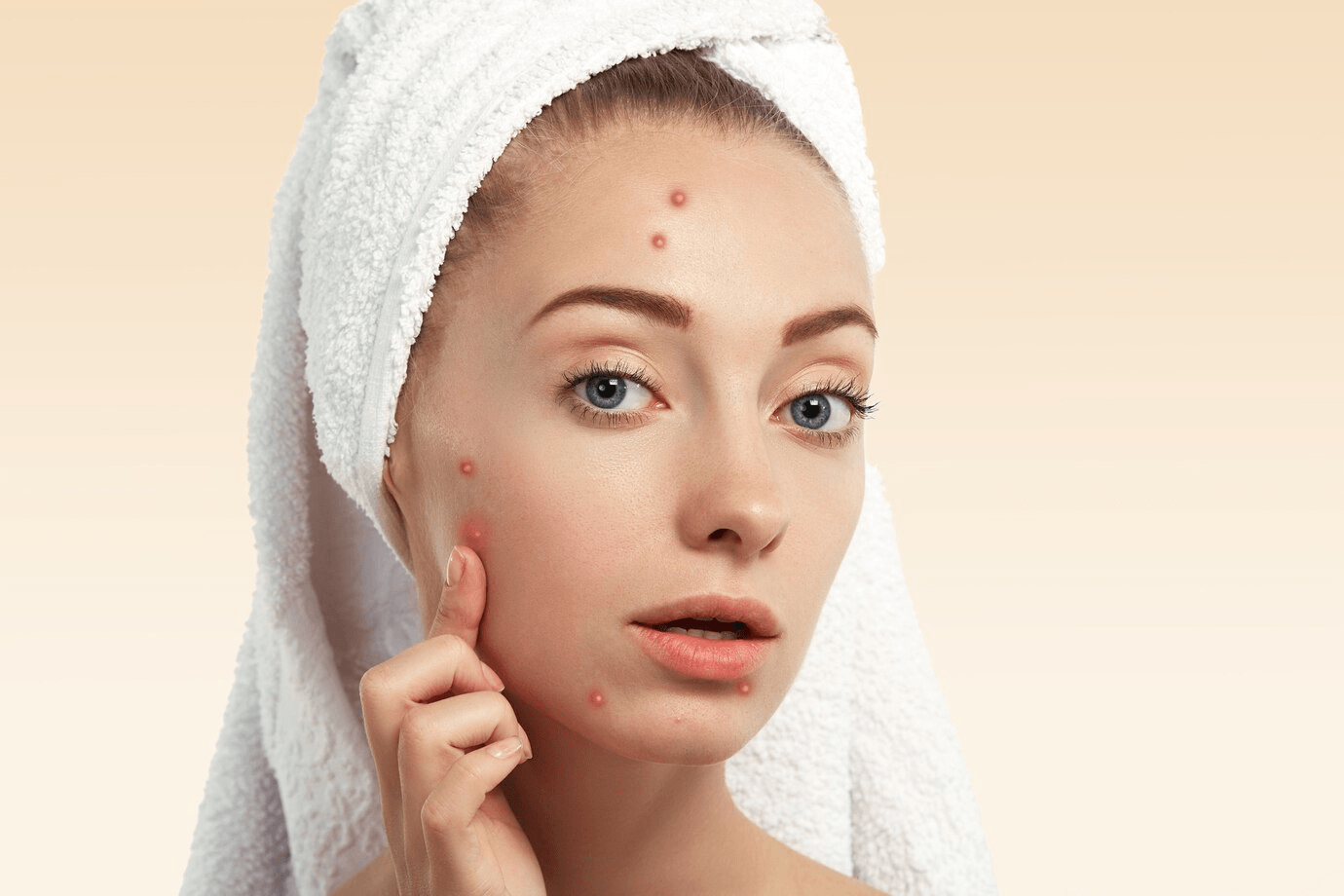 Top 5 Skin care Products for Acne